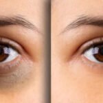 Before and after dark circles treatment results showing improvement under the eyes.