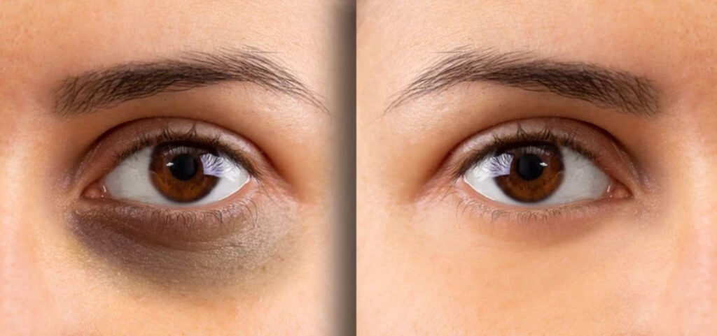 Before and after dark circles treatment results showing improvement under the eyes.